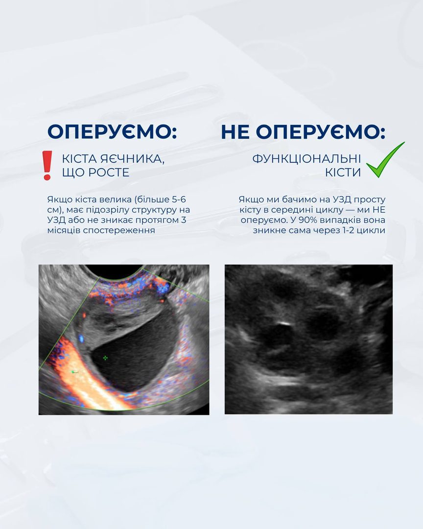 Кіста яєчника — коли оперувати