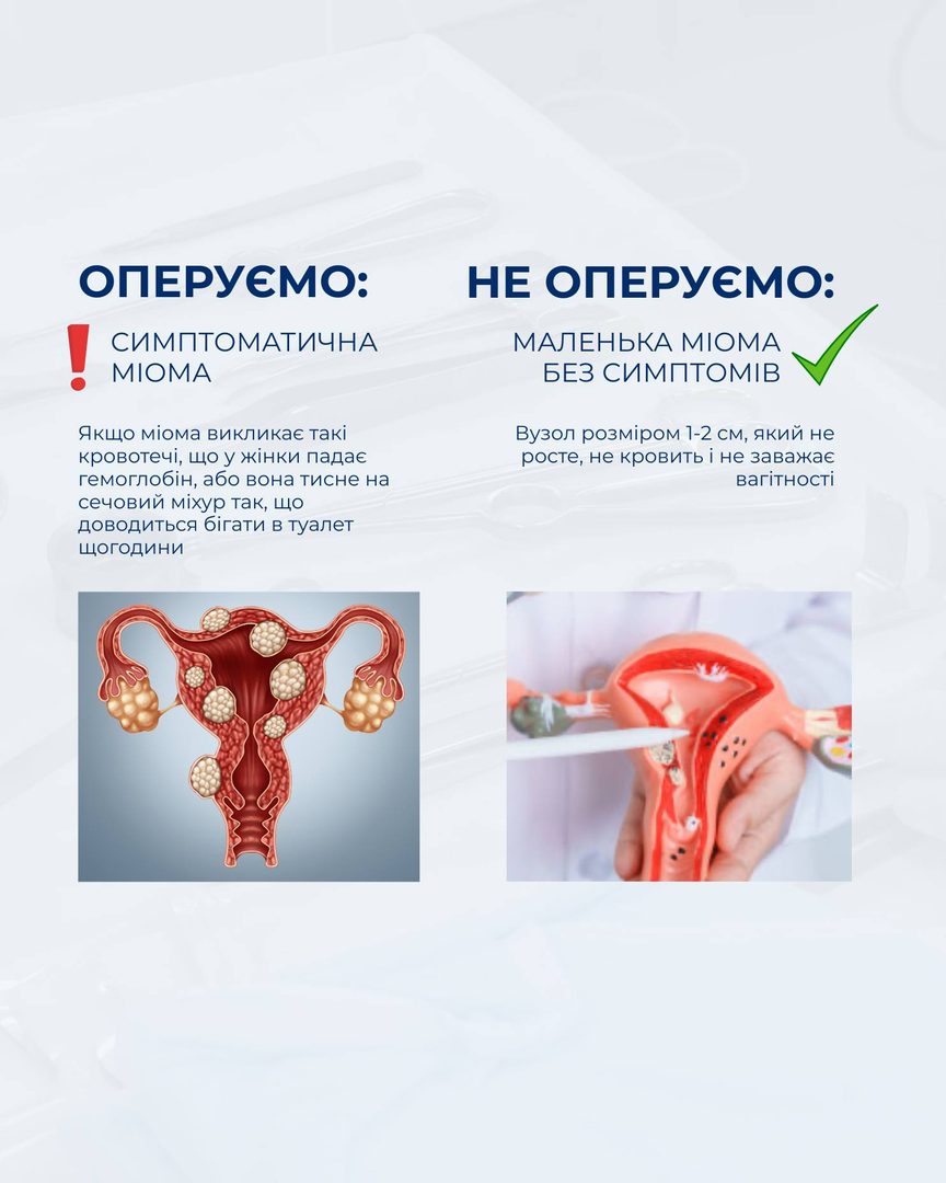 Міома — коли оперувати