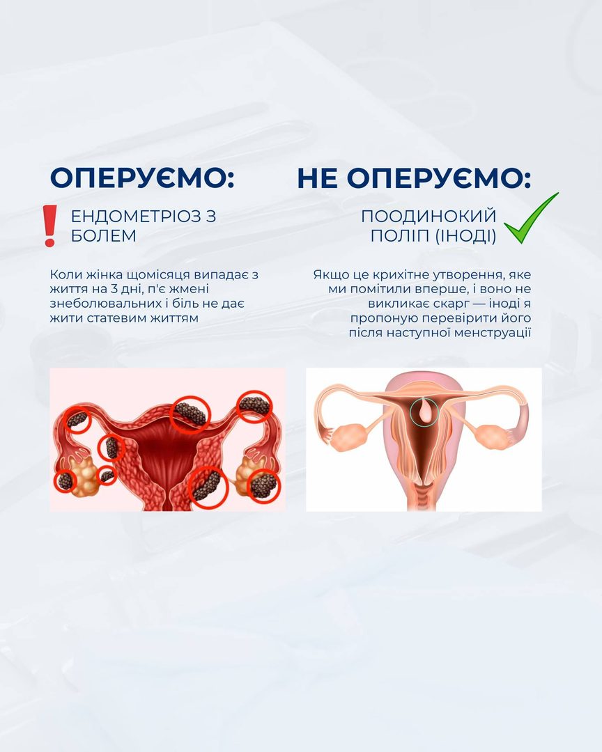Ендометріоз і поліпи — коли оперувати